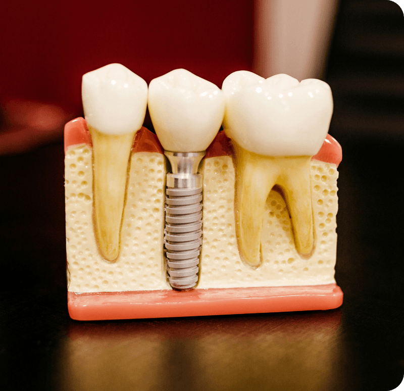 Fogászati implantátum felépítése