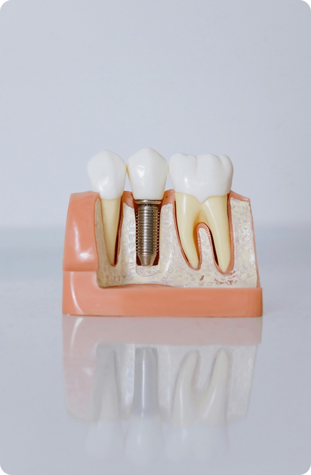 fogászati implantátum
